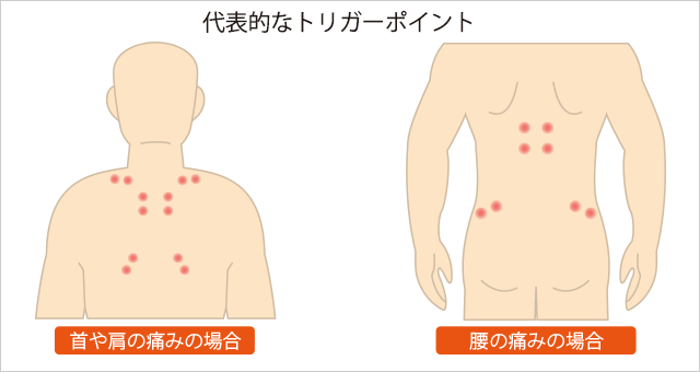 代表的なトリガーポイント